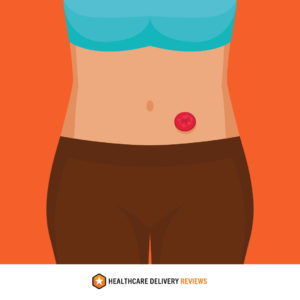 A woman with a stoma